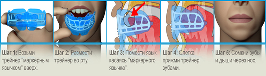 Показания противопоказания ортодонтических аппаратов